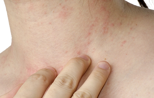 ¿Qué es un eccema?