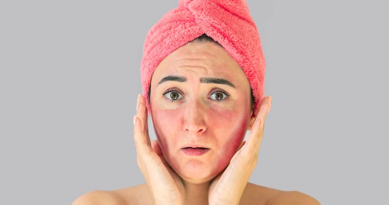 Rosácea y cambios de temperatura: cuidados clave